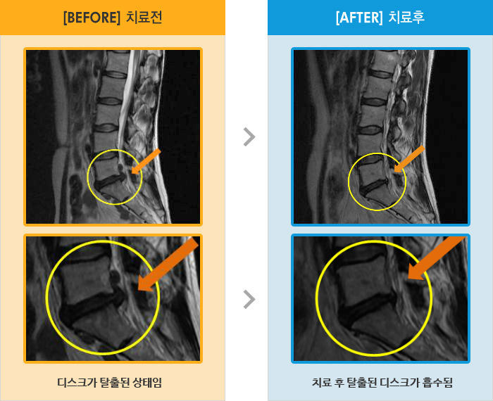 자생한방병원 치료사례 MRI로 보는 치료결과-우측엉덩이 허벅지 종아리 발목에 통증과 족하수