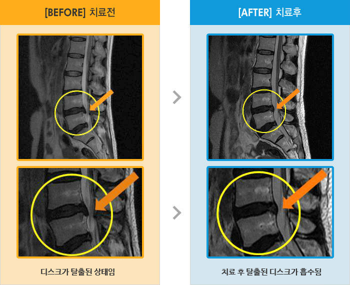 자생한방병원 치료사례 MRI로 보는 치료결과-보행시 왼측 골반 통증, 좌측 오금으로 시큰거리는 증상