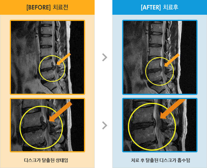 자생한방병원 치료사례 MRI로 보는 치료결과-허리를 숙일때 통증, 우측 허벅지에서 무릎으로 저림, 발 딛을시 감각 없음