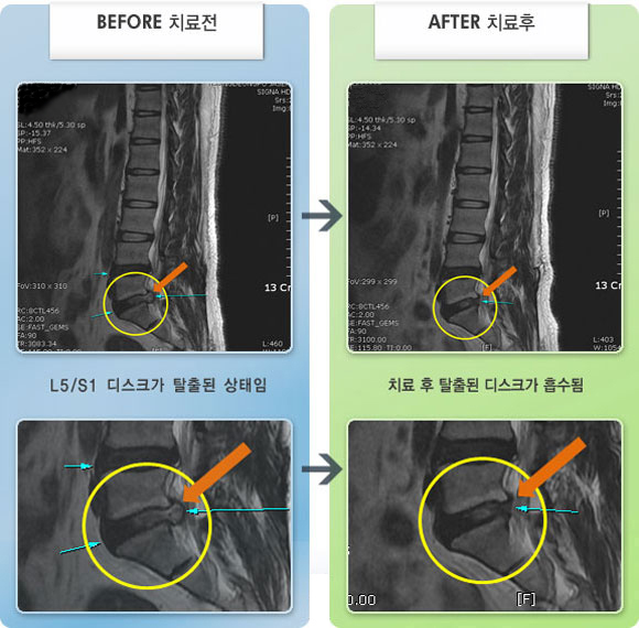 자생한방병원 치료사례 MRI로 보는 치료결과-다른 병원에서 허리 디스크 수술을 받은 후 심한 양상의 좌측 하지 통증이 발생