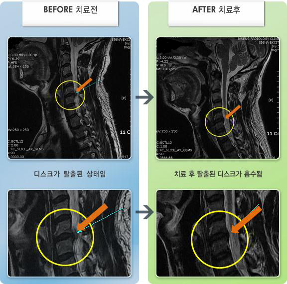 자생한방병원 치료사례 MRI로 보는 치료결과-목과 오른쪽 팔 통증이 심해서 움직이기 힘든 상태