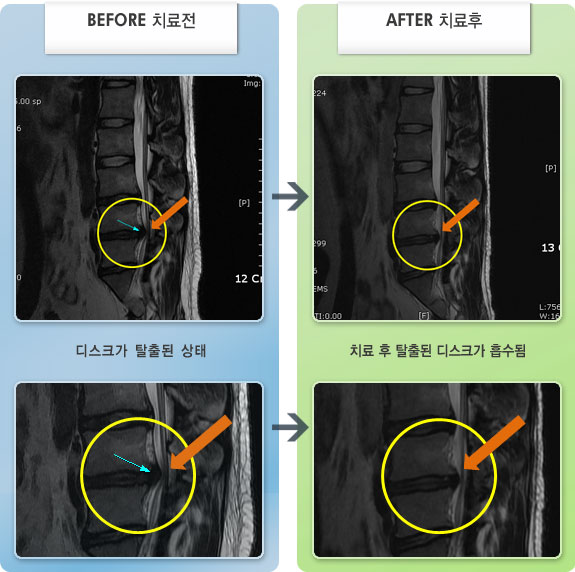자생한방병원 치료사례 MRI로 보는 치료결과-허리 디스크로 수술을 받고 지내던중 다시 디스크가 재발
