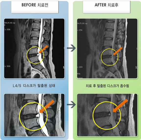 자생한방병원 치료사례 MRI로 보는 치료결과-왼쪽 엉치부터 다리 옆으로 당기고 저림