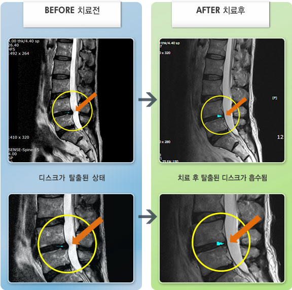 자생한방병원 치료사례 MRI로 보는 치료결과-좌측 허리 통증이 극심하였다.