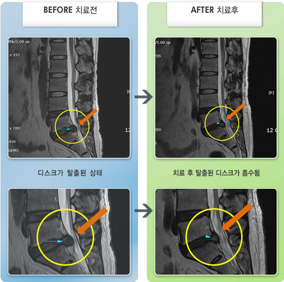 자생한방병원 치료사례 MRI로 보는 치료결과-허리, 오른쪽 둔부, 다리 통증이 심하여 바로 눕기 힘든 상태