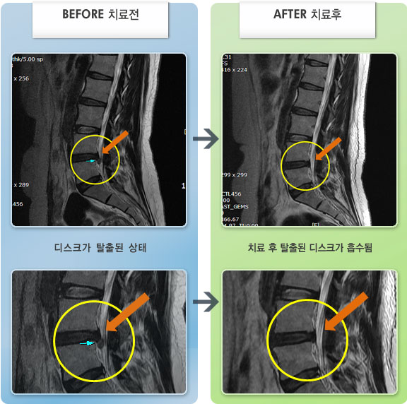자생한방병원 치료사례 MRI로 보는 치료결과-좌측 둔부 통증과 하지의 심한 방사통이 있었다.