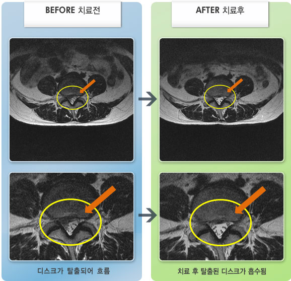자생한방병원 치료사례 MRI로 보는 치료결과-허리 통증과 우측 엉치 통증 및 허벅지 후면 이상감각으로 자생을 찾았다.