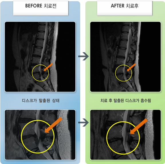 자생한방병원 치료사례 MRI로 보는 치료결과-허리와 우측 엉덩이로 찌르는 통증과 우측 하지가 저림