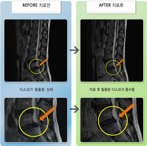 자생한방병원 치료사례 MRI로 보는 치료결과-허리 뻐근한 통증과 좌측 하지 당김이 심해 걷기가 힘든 상태