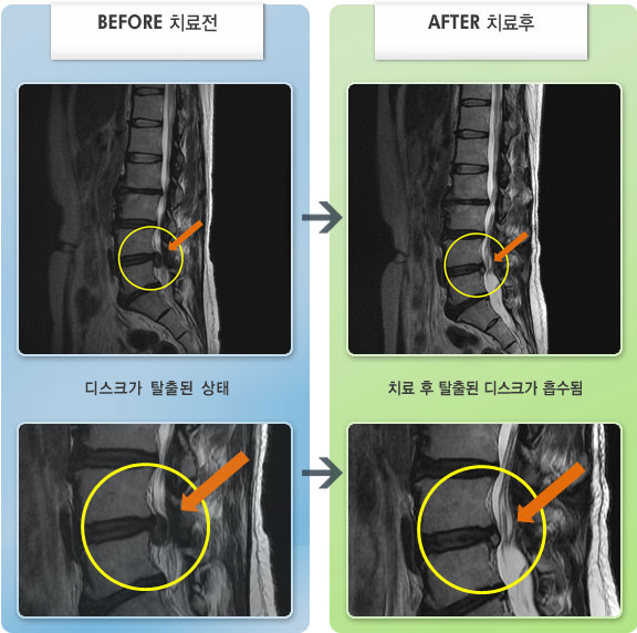 자생한방병원 치료사례 MRI로 보는 치료결과-허리 통증과 좌측의 심한 하지 방산통으로 일상생활이 어려운 상태