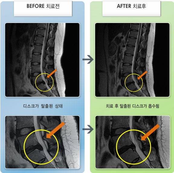 자생한방병원 치료사례 MRI로 보는 치료결과-요통과 우측 다리 저림이 심해 야간에 수면이 어려운 상태