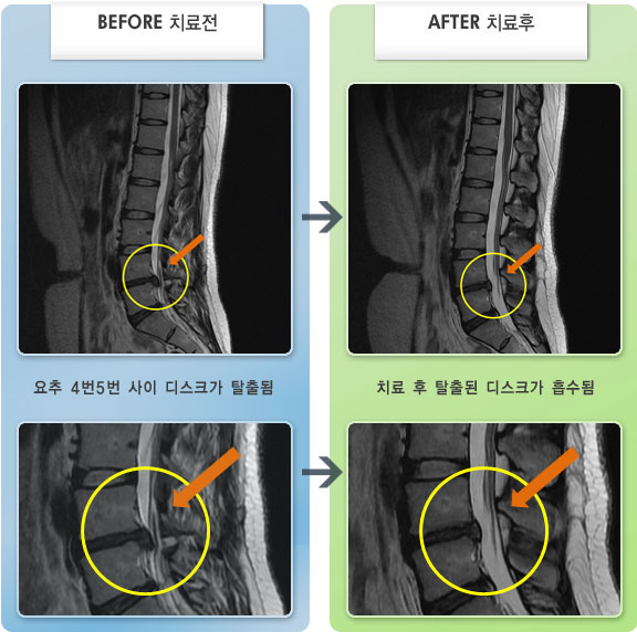자생한방병원 치료사례 MRI로 보는 치료결과-우측 허리와 엉덩이 부위에 통증과 다리 저림