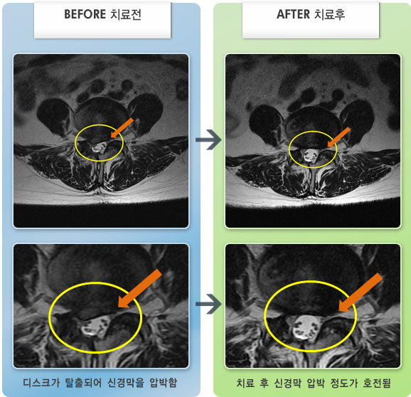 자생한방병원 치료사례 MRI로 보는 치료결과-디스크 수술후 재발하여 우측 허리와 다리 통증이 심한 상태