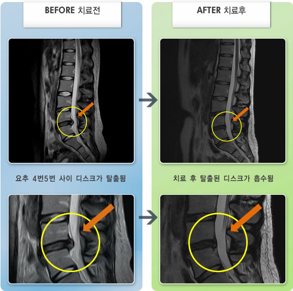 자생한방병원 치료사례 MRI로 보는 치료결과-허리와 엉치 통증과 다리 저림 증상