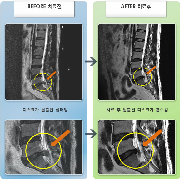 자생한방병원 치료사례 MRI로 보는 치료결과-허리 통증과 우하지 당기는 증상