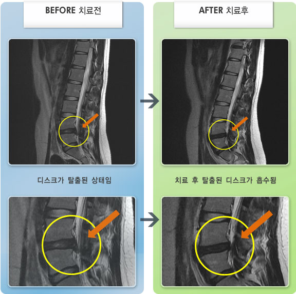 자생한방병원 치료사례 MRI로 보는 치료결과-우측 허리 불편감 및 심한 엉치 통증