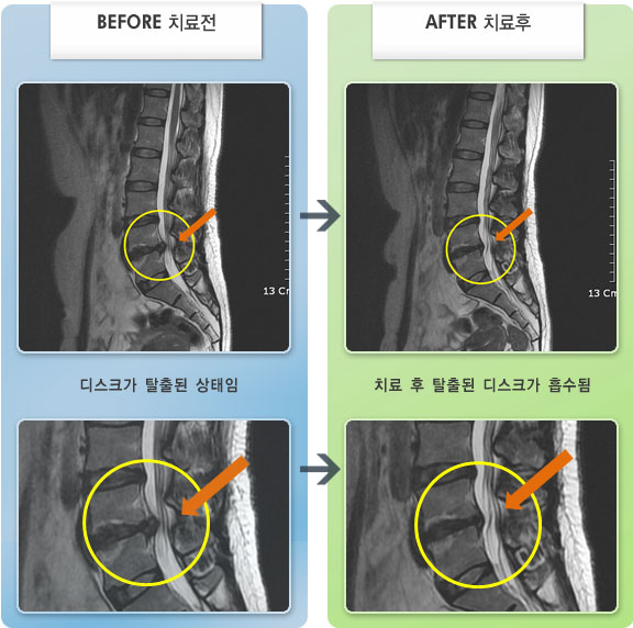 자생한방병원 치료사례 MRI로 보는 치료결과-허리디스크로 인한 허리 통증 및 다리 방산통
