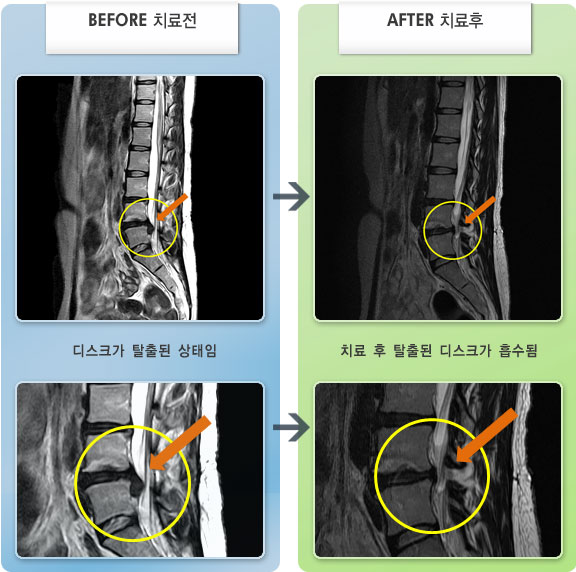 자생한방병원 치료사례 MRI로 보는 치료결과-허리디스크로 인한 허리 통증