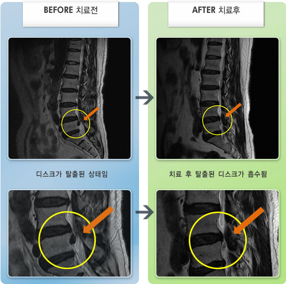 자생한방병원 치료사례 MRI로 보는 치료결과-허리디스크로 인한 좌측 대퇴 외측면의 견인통 및 저림 증세