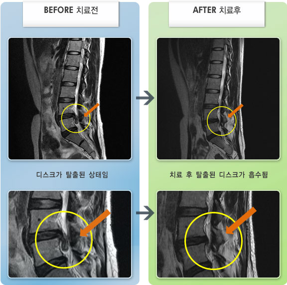 자생한방병원 치료사례 MRI로 보는 치료결과-허리디스크로 인한 양측 요추부 통증