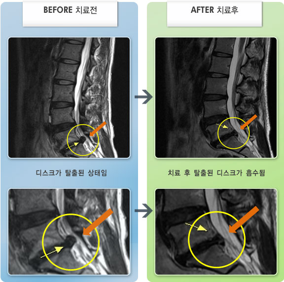 자생한방병원 치료사례 MRI로 보는 치료결과-우측 허리 통증과 하지 저림