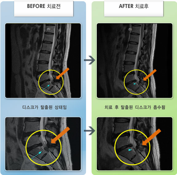 자생한방병원 치료사례 MRI로 보는 치료결과-요통 및 우하지 방사통