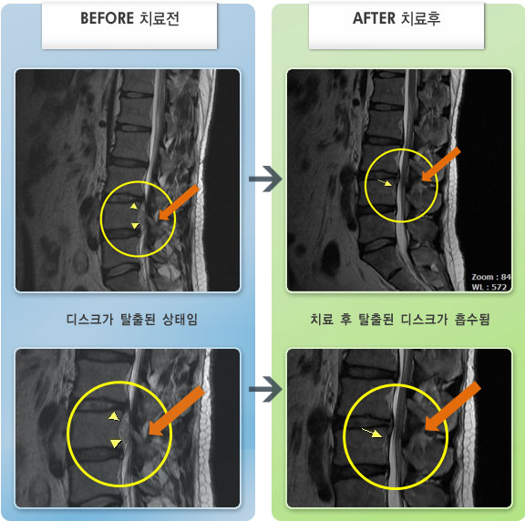 자생한방병원 치료사례 MRI로 보는 치료결과-허리디스크로 인한 우측 다리 저림 증상