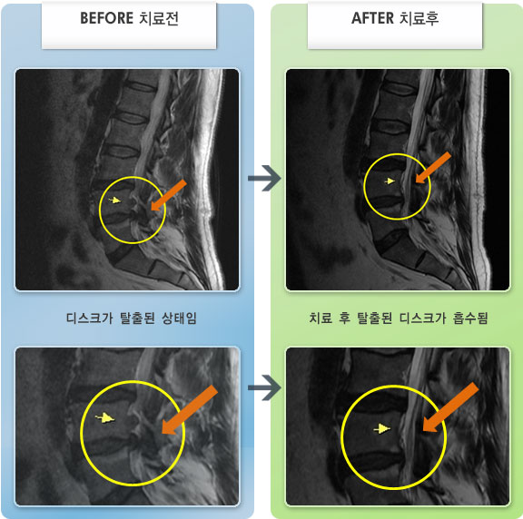 자생한방병원 치료사례 MRI로 보는 치료결과-허리 가운데 통증있고 왼쪽 고관절, 무릎 바깥쪽으로 통증이 있었다.