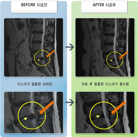 자생한방병원 치료사례 MRI로 보는 치료결과-허리디스크로 인한 종아리 저림 증상