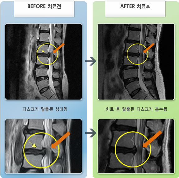 자생한방병원 치료사례 MRI로 보는 치료결과-허리디스크로 인한 허리 및 다리 통증