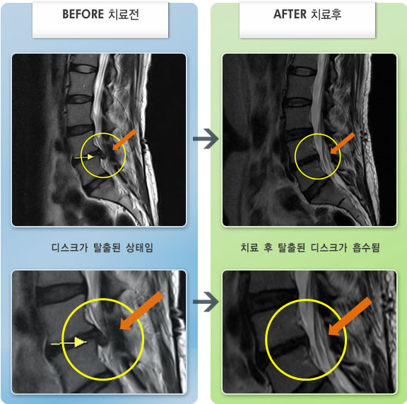 자생한방병원 치료사례 MRI로 보는 치료결과-자세변경시 허리 통증이 심하였다.