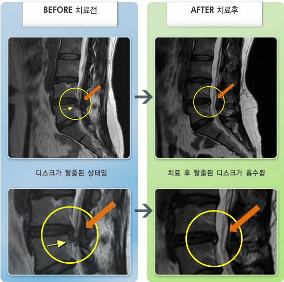 자생한방병원 치료사례 MRI로 보는 치료결과-허리 통증과 좌하지 방산통