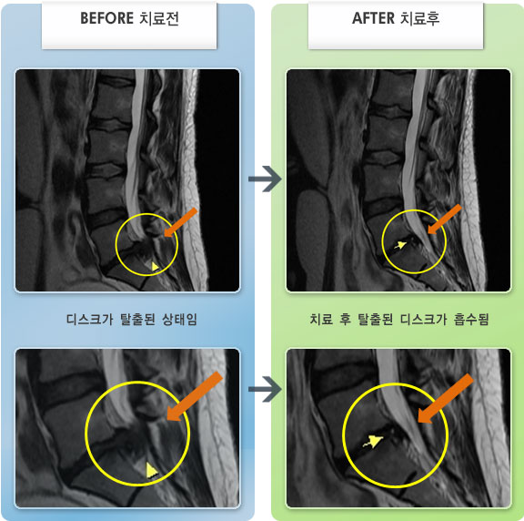 자생한방병원 치료사례 MRI로 보는 치료결과-허리디스크로 인한 우측 종아리 당김 증상