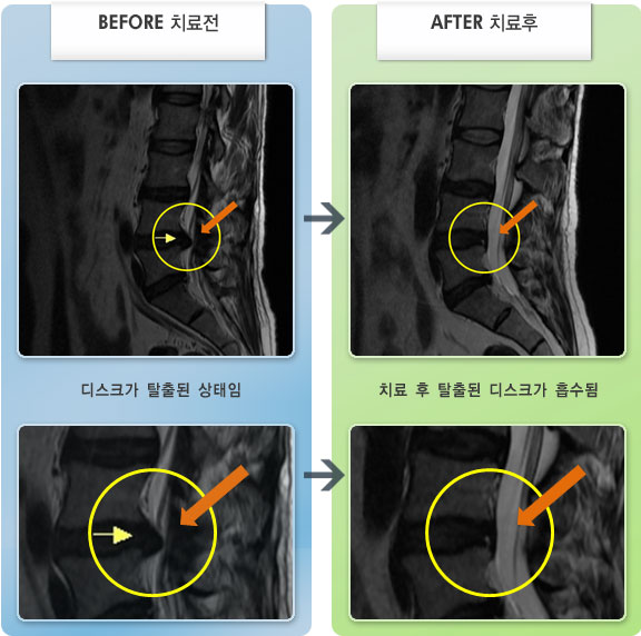자생한방병원 치료사례 MRI로 보는 치료결과-허리디스크로 인한 허리 통증 및 결림 증상