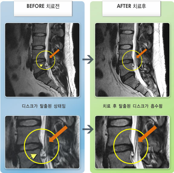 자생한방병원 치료사례 MRI로 보는 치료결과-허리디스크로 인한 허리 및 오른쪽 엉치 통증