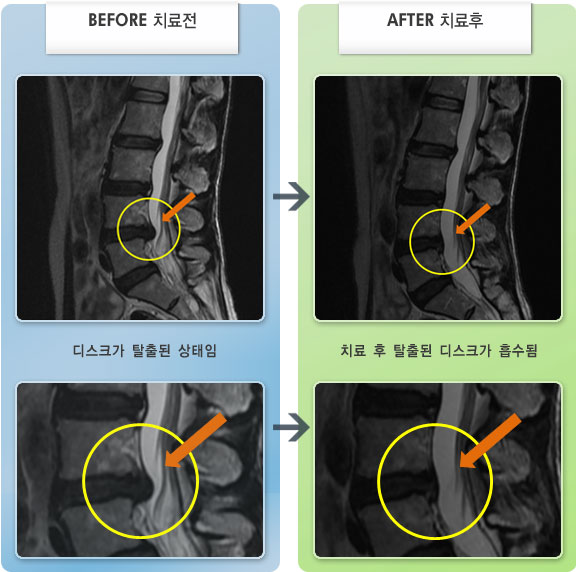 자생한방병원 치료사례 MRI로 보는 치료결과-허리디스크로 인한 좌측 허리 및 엉치 다리 불편감