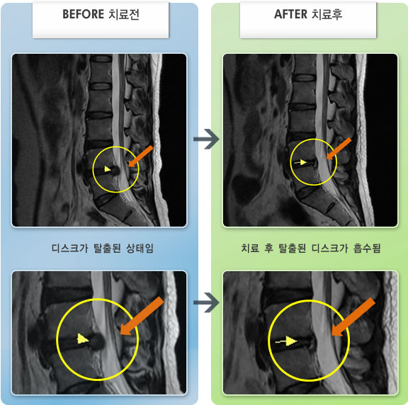 자생한방병원 치료사례 MRI로 보는 치료결과-허리 통증과 왼쪽 엉치에서 다리 당김이 있었다.
