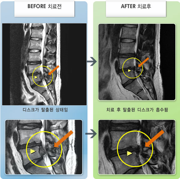 자생한방병원 치료사례 MRI로 보는 치료결과-허리디스크로 인한 좌측 하지 통증
