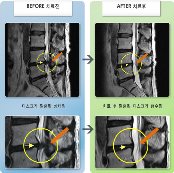 자생한방병원 치료사례 MRI로 보는 치료결과-왼쪽 엉치에서 종아리 외측 통증