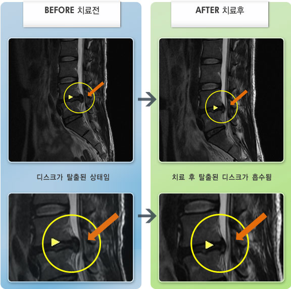 자생한방병원 치료사례 MRI로 보는 치료결과-보행시 좌측 다리 저림 증상