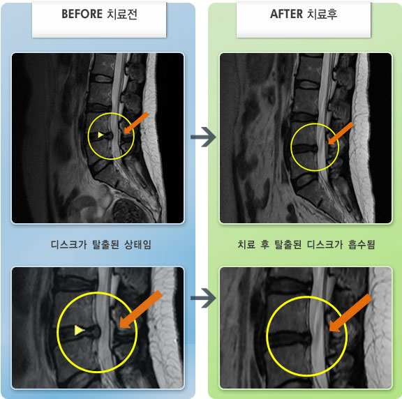 자생한방병원 치료사례 MRI로 보는 치료결과-허리디스크로 인한 허리 통증 및 다리 저림 증상
