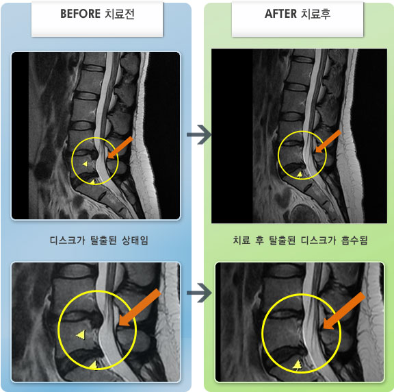 자생한방병원 치료사례 MRI로 보는 치료결과-허리 통증과 양쪽 골반에서 허벅지 앞쪽 통증 및 저림 증상