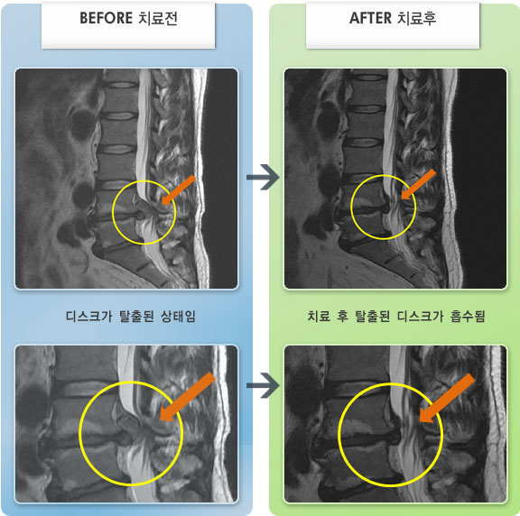 자생한방병원 치료사례 MRI로 보는 치료결과-오른쪽 허벅지, 종아리 저림 증상