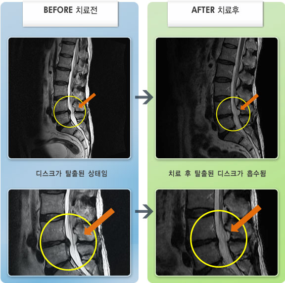자생한방병원 치료사례 MRI로 보는 치료결과-허리디스크로 인한 왼쪽 허리, 엉치 통증