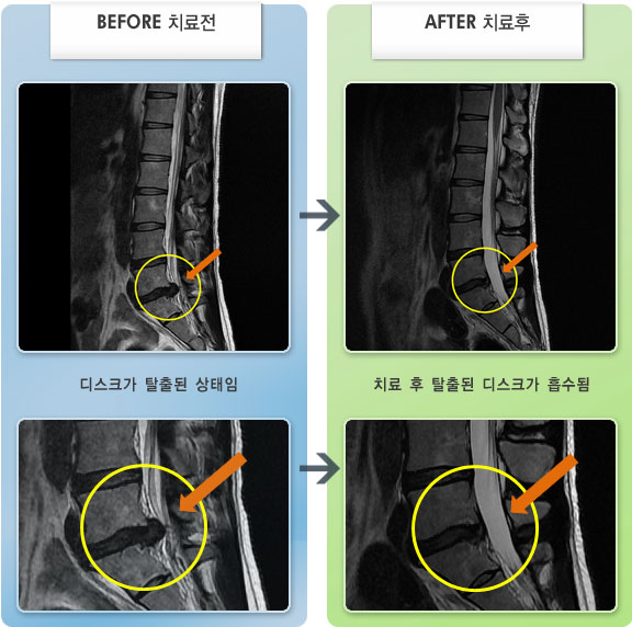 자생한방병원 치료사례 MRI로 보는 치료결과-좌측 대퇴부 저림 증상