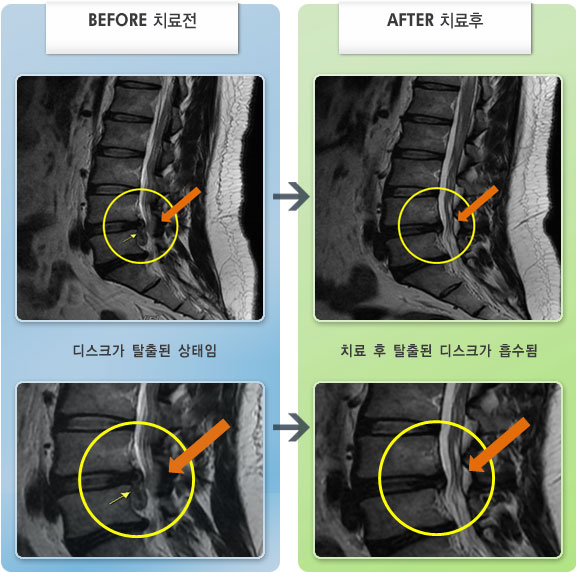 자생한방병원 치료사례 MRI로 보는 치료결과-허리디스크로 인한 보행시 다리 방사통