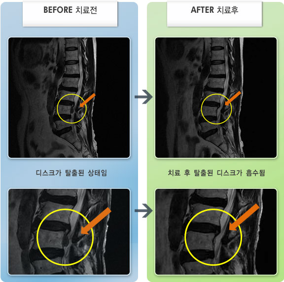 자생한방병원 치료사례 MRI로 보는 치료결과-왼쪽 허벅지와 종아리 통증