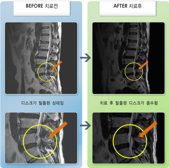 자생한방병원 치료사례 MRI로 보는 치료결과-좌측 허리 엉덩이 통증과 좌측 허벅지 종아리로 저리고 당기는 통증