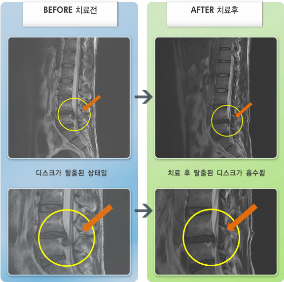 자생한방병원 치료사례 MRI로 보는 치료결과-왼쪽 골반에서 종아리까지 보행이 힘들 정도로 통증