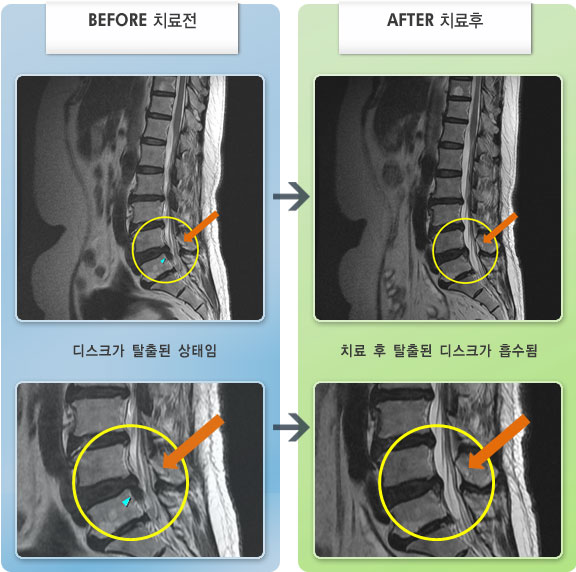자생한방병원 치료사례 MRI로 보는 치료결과-좌측 허리, 엉덩이 부위 통증과 다리 저림 당김 증상